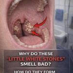 Why Do Small White “Stones” in the Mouth Smell Bad? Causes, Formation & Simple Solutions