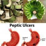 Natural Remedies for Stomach Ulcers & H. pylori: Plantain Peel Treatment