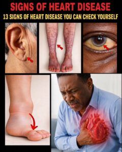 13 Visible Signs of Heart Disease You Can Check Yourself Every Day
