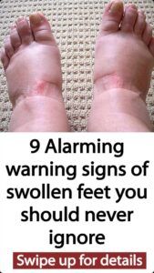 9 Alarming Warning Signs of Swollen Feet You Should Never Ignore