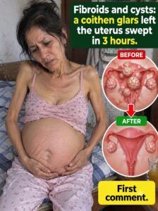 Fibroids and cysts: what nobody tells you about swelling and discomfort