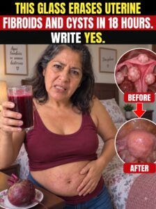 Myths about fibroids and uterine cysts: what actually helps and what just wastes your time