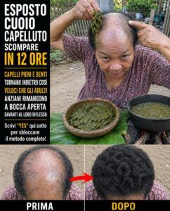 Le zone calve rimangono vuote quando i follicoli del cuoio capelluto si ostruiscono: la foglia di papaya inizia a ripulire il cuoio capelluto.