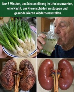 Schäumender Urin bedeutet, dass Ihre Nierenfilter Eiweiß durchlassen.