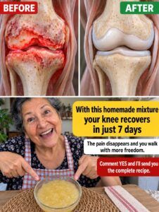 Restore Your Knee Health with This Homemade Mixture in Just 7 Days