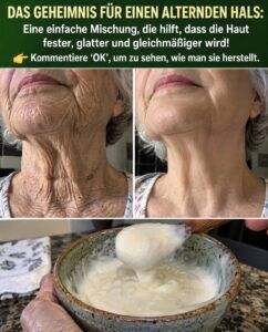 Knitterflecken am Hals verschwinden, wenn diese Paste aus dem Vorratsschrank auf die Haut aufgetragen wird.