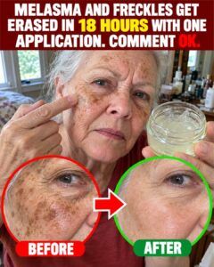 One Application Triggers a Fast Melasma Reset in Aging Skin