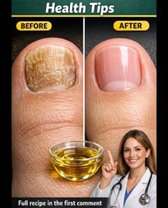 Homemade Remedy for Nail Fungus: The Natural Formula That Really Works