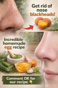 Get Rid of Nose Blackheads: The Incredible Homemade Egg Recipe