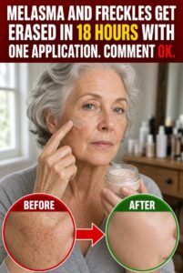 Erase Melasma and Freckles: The One-Application Method for Aging Skin