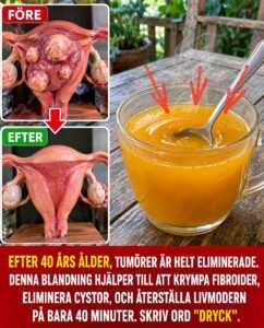 Efter 40: det ångande glaset som sägs krympa myom och rensa cystor