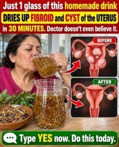 This Homemade Drink Attacks Uterine Fibroids and Cysts — And the Mechanism Is Frightening