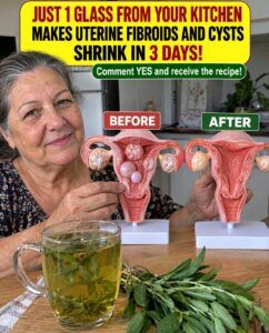 Just 1 Glass of This Infusion Can Reduce Fibroids and Cysts in the Uterus